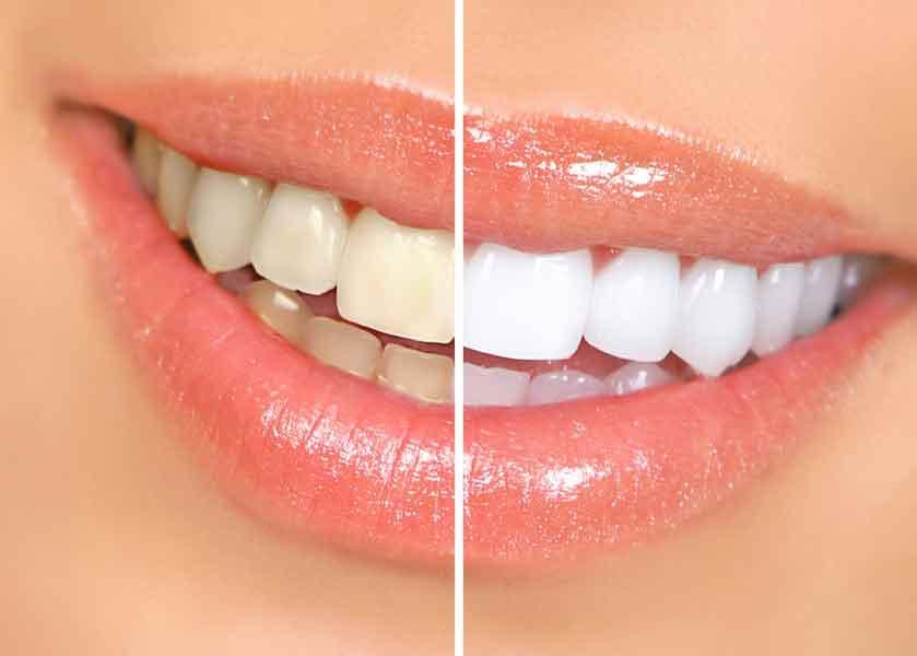Before and after professional teeth whitening results
